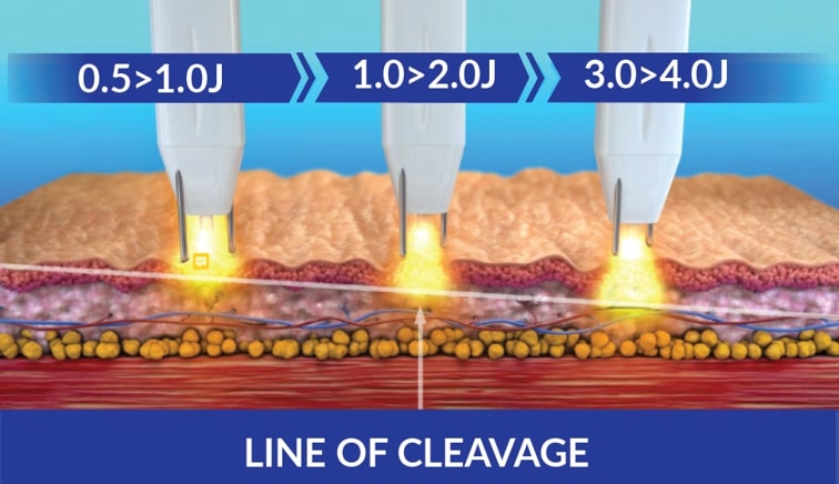 Line of cleavage